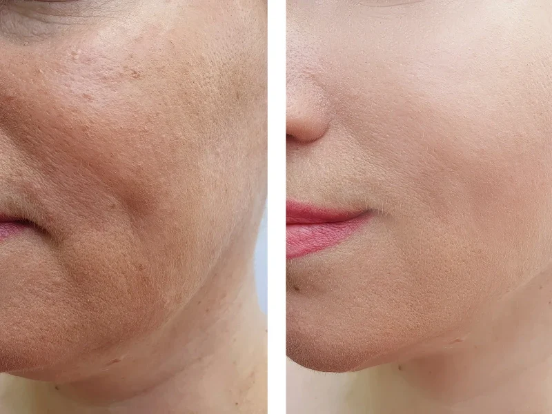 laser skin resurfacing results