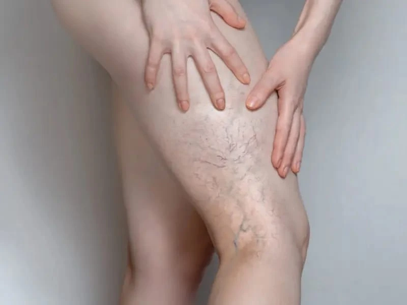 Benefits of Spider Veins Treatment