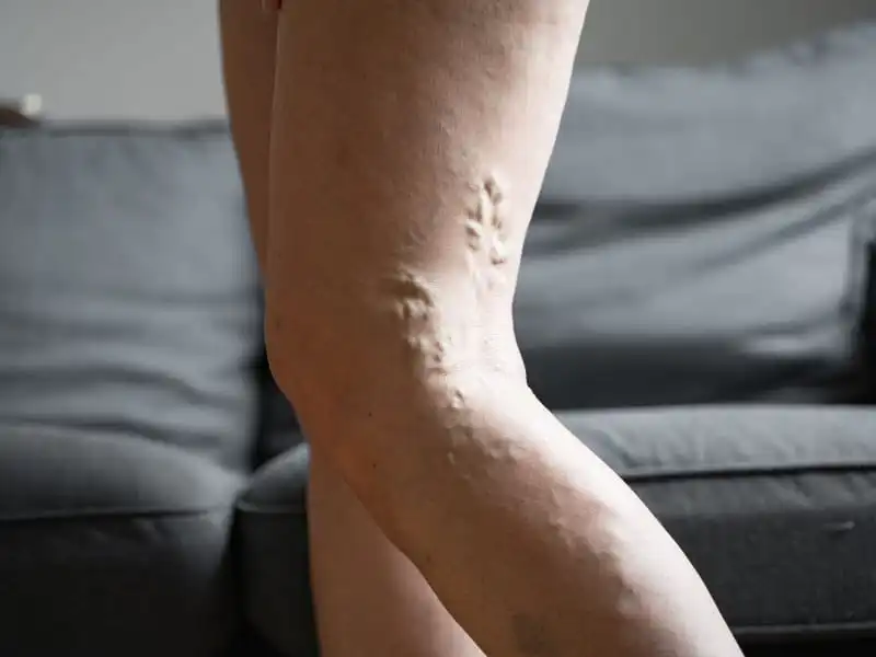 benefits of varicose veins therapy