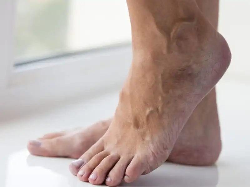 sclerotherapy for varicose veins removal