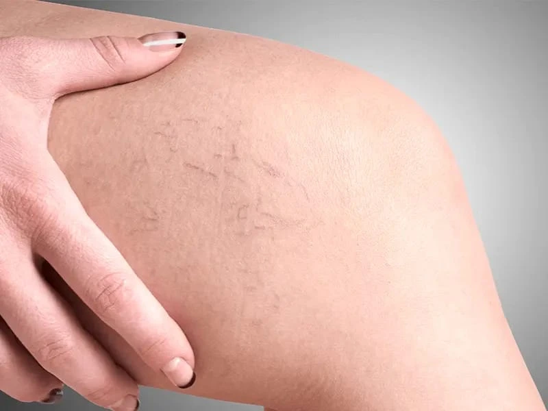spider-veins-treatment-cost