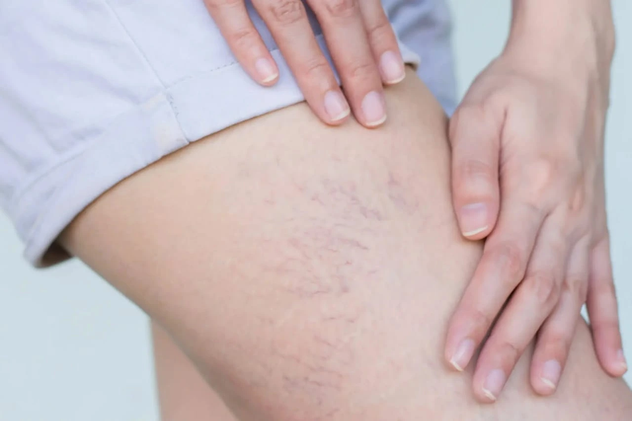 spider-veins-treatment-in-lake-forest-ca