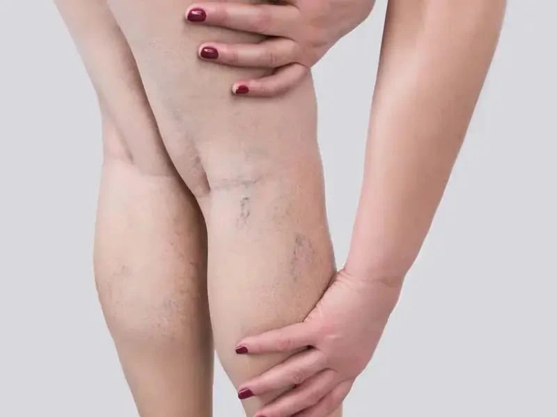 spider-veins-treatment