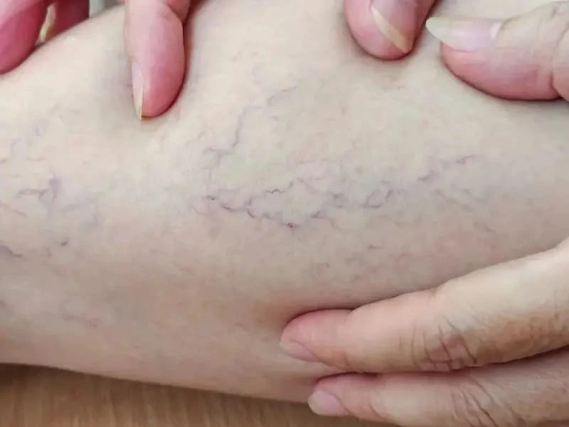 What Are Spider Veins?