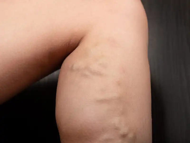 what are varicose veins?