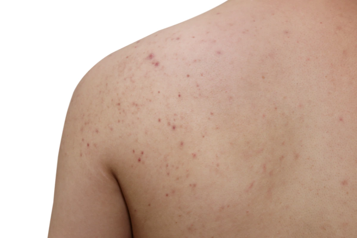 Professional Back Acne Treatment in Lake Forest, CA