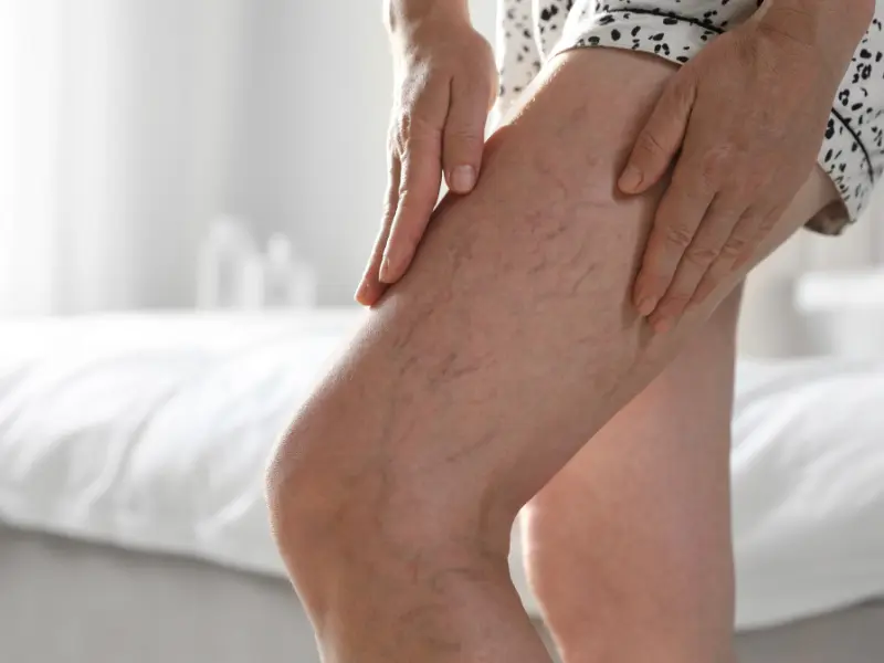 Sclerotherapy For Spider Veins Removal