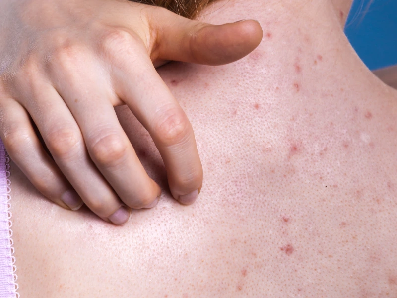 back acne treatment candidates