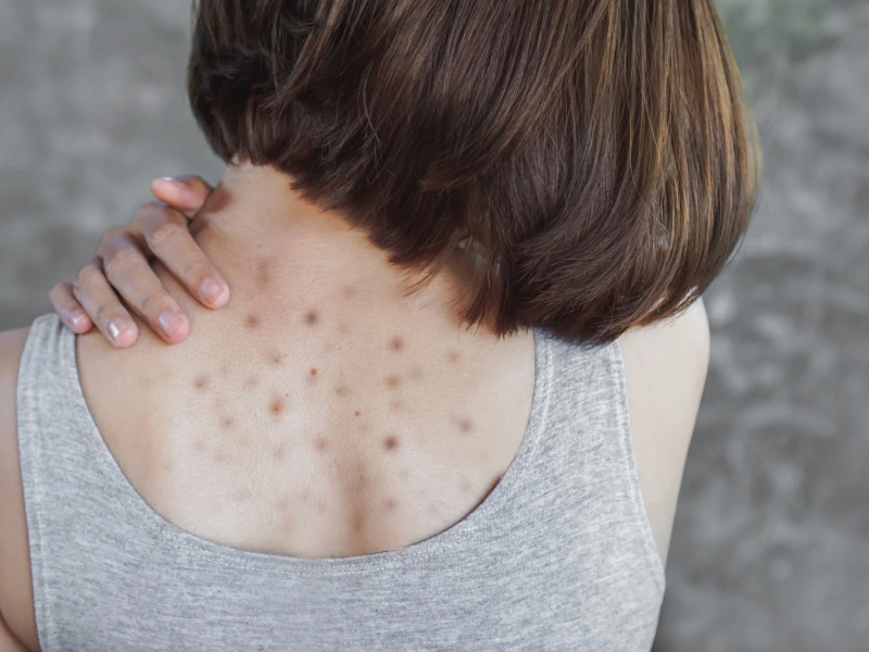 back acne treatment in Irvine & Lake Forest, CA