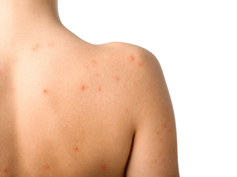 back acne treatment cost