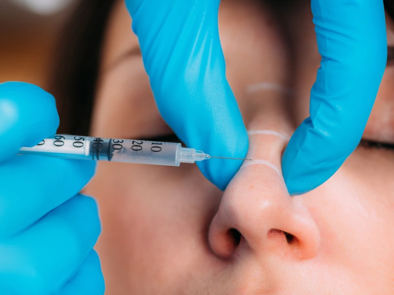 restylane procedure