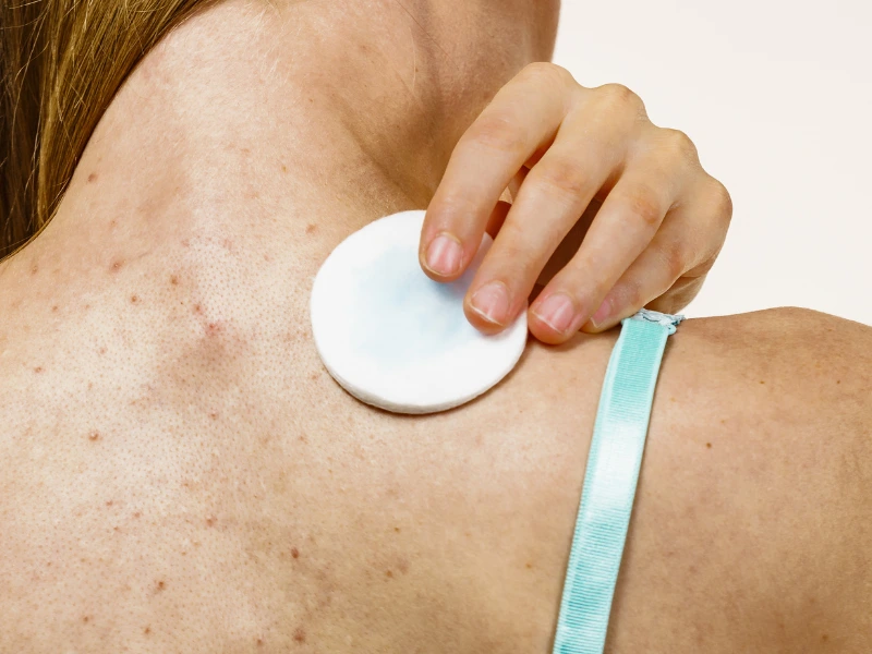 back acne treatment before and after