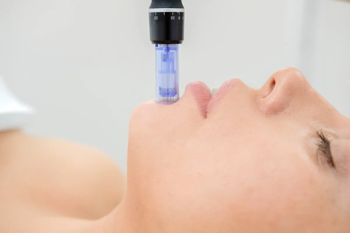 microneedling treatment