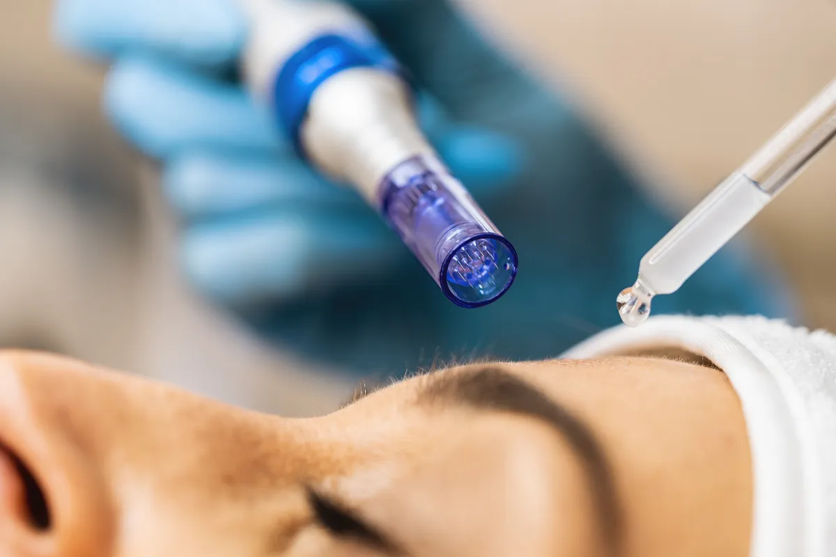 prp microneedling in lake forest, ca