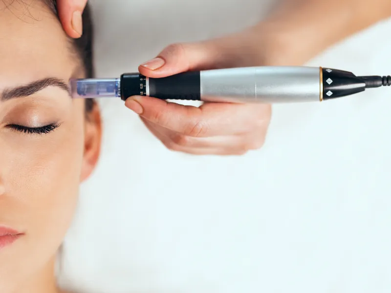 what is prp microneedling?