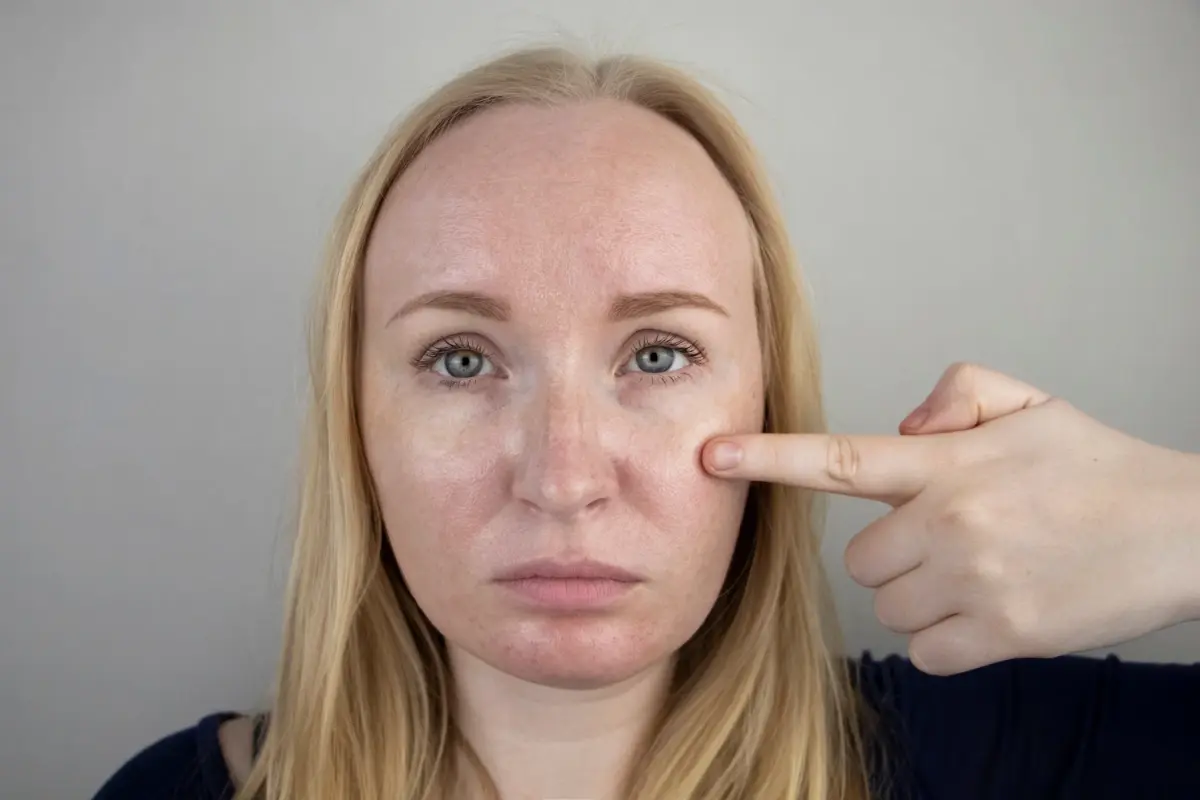 candidates for hyperpigmentation