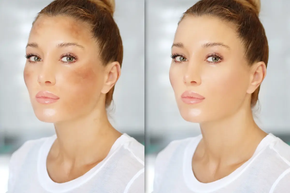 hyperpigmentation results