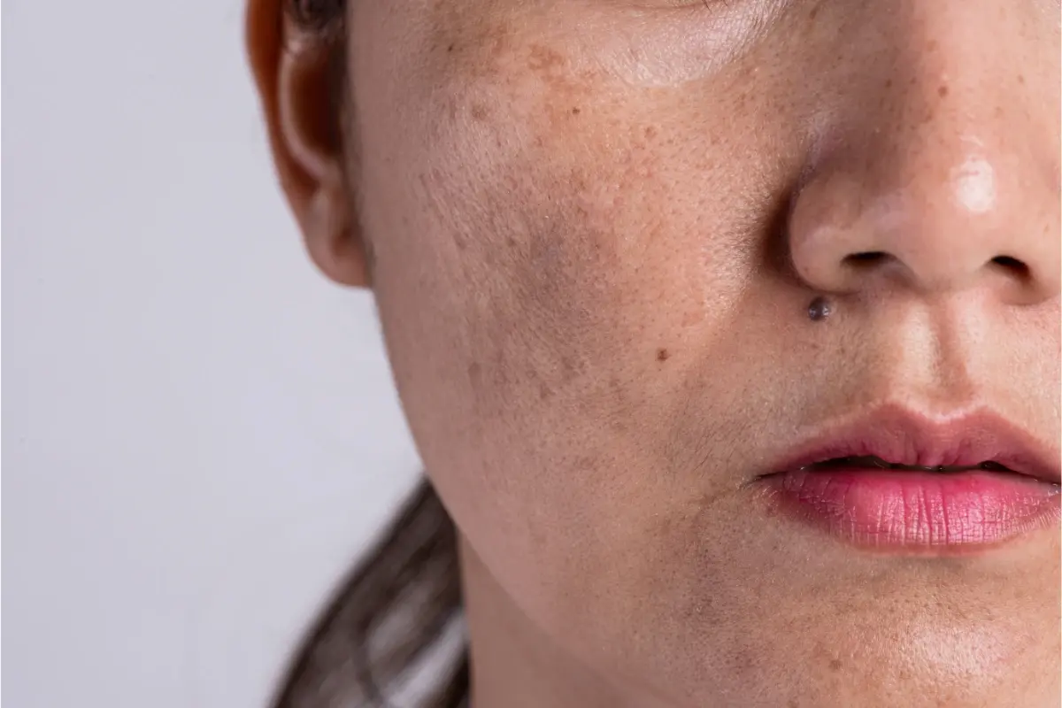 hyperpigmentation treatment