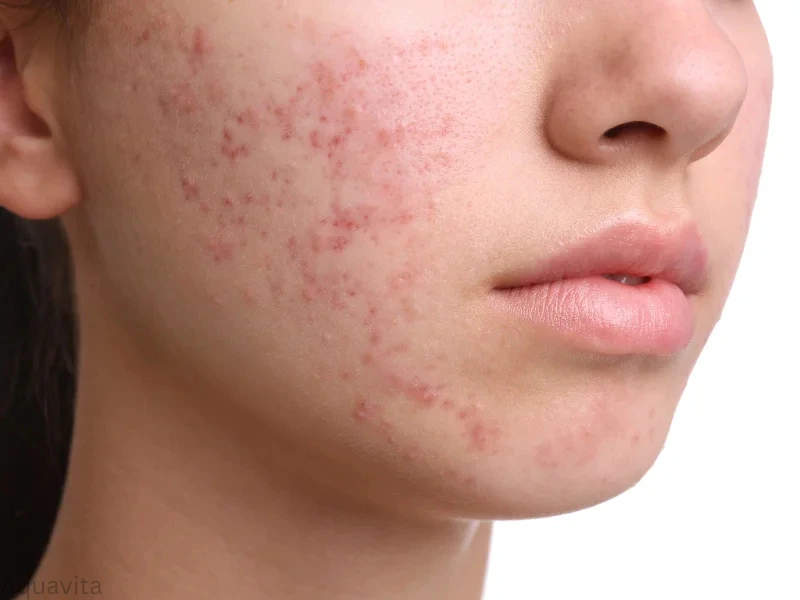 acne treatment lake forest ca