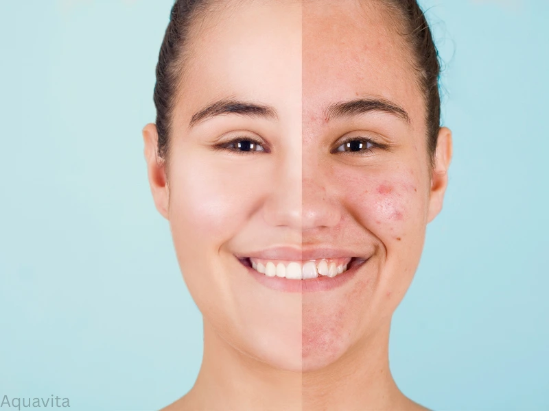 acne treatment results