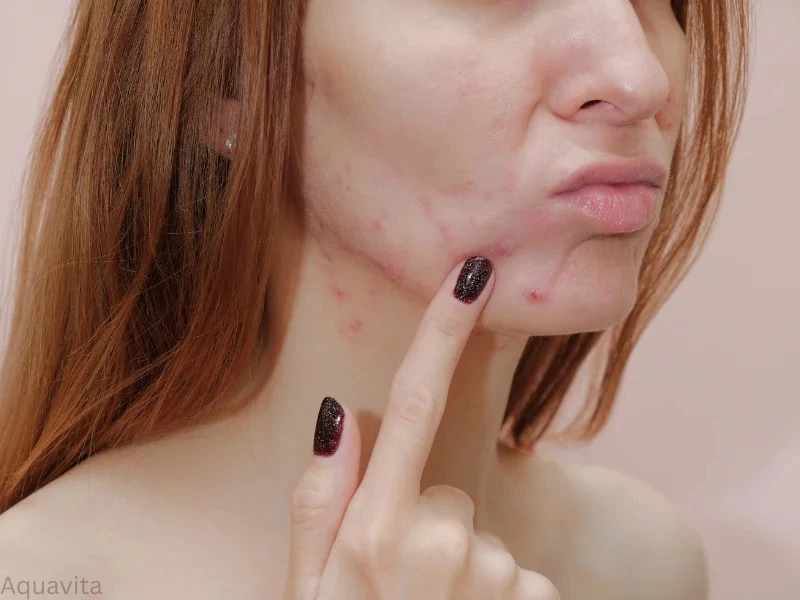 benefits of acne treatment