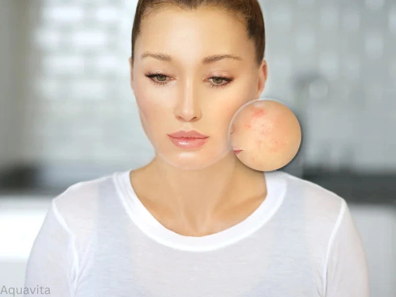 candidates for acne treatment
