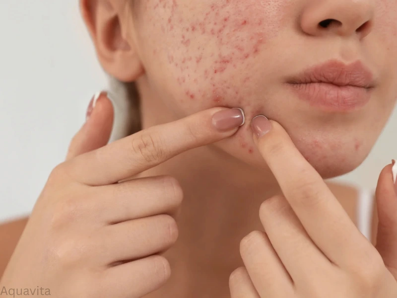 what is acne treatment