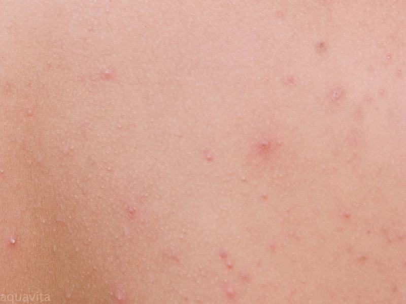 back acne causes