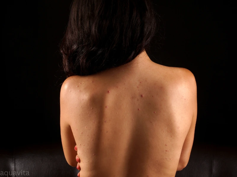 best way to get rid of acne on the back