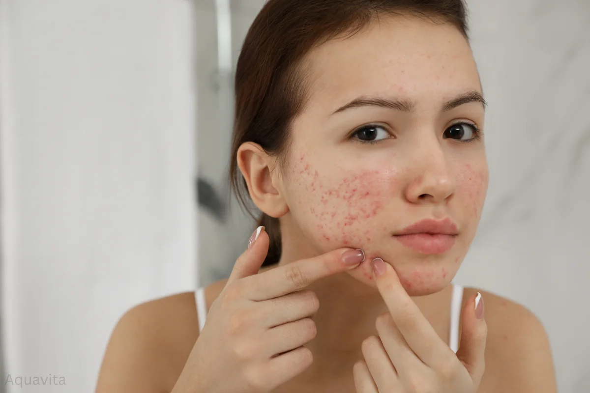 clearing acne scars