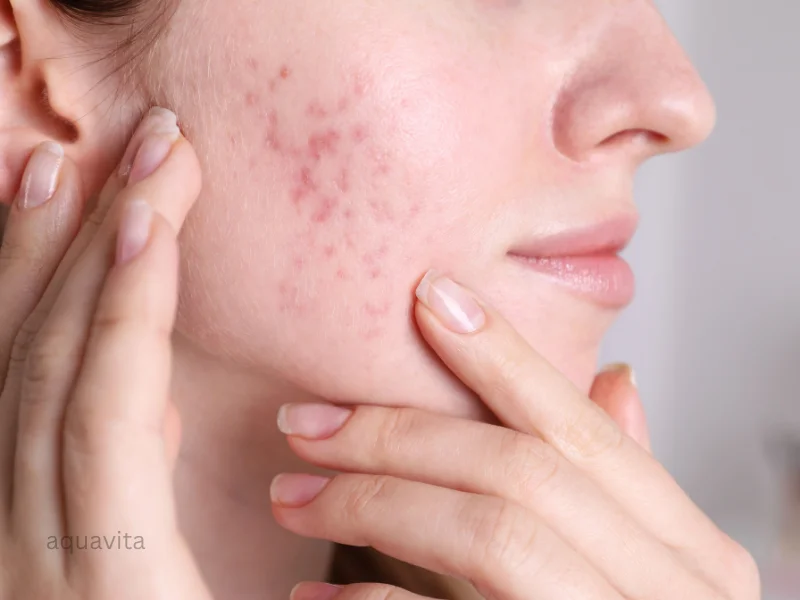 fungal acne management