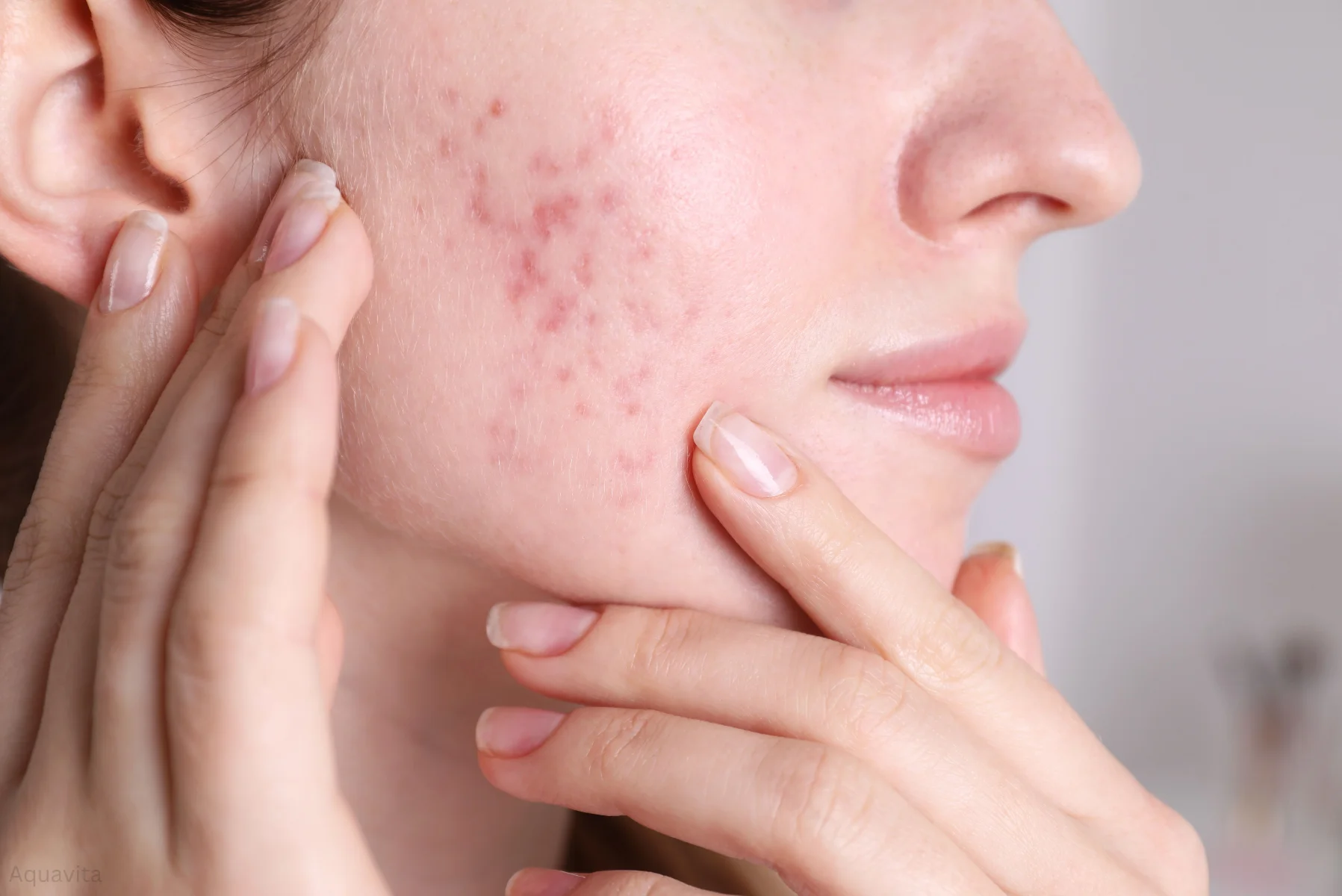 how to get rid of acne scars
