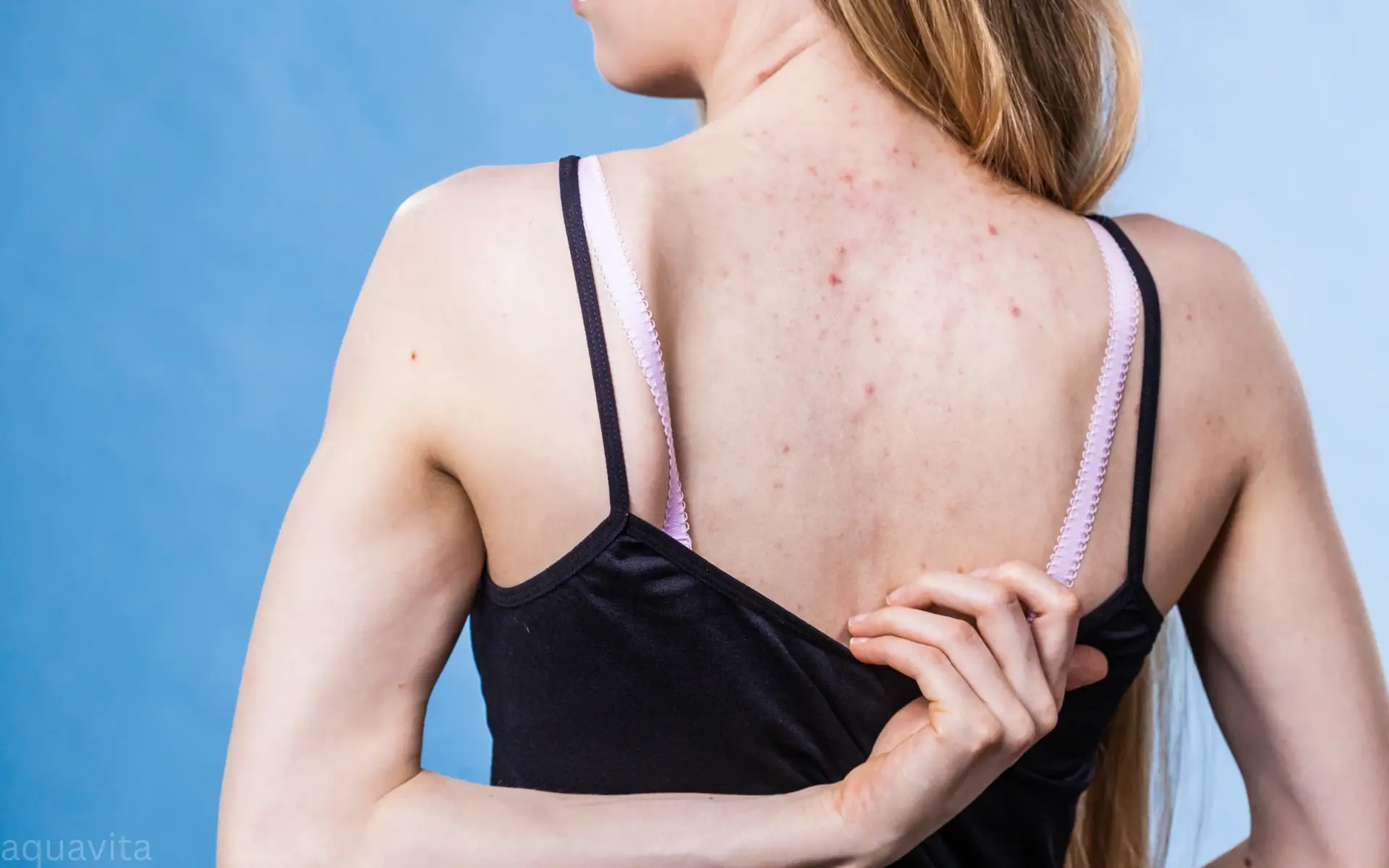 how to get rid of back acne