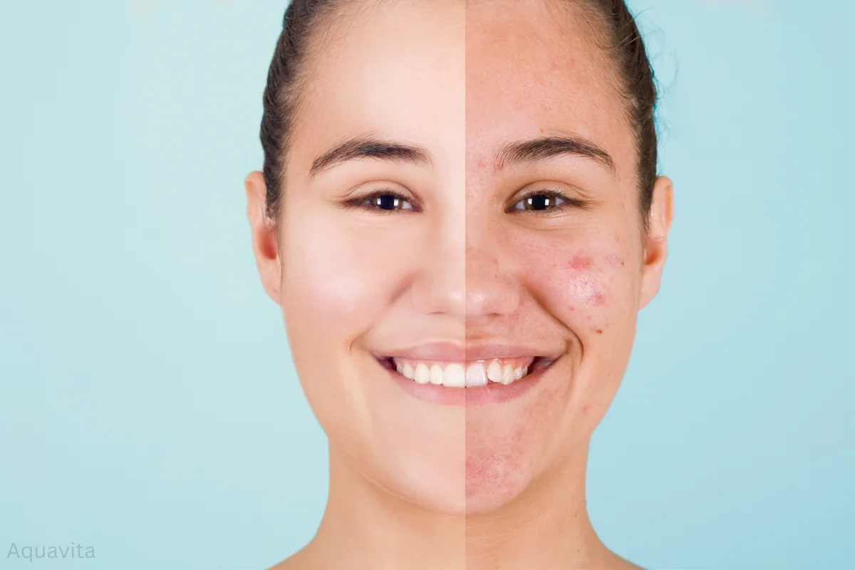 reduce acne and scars