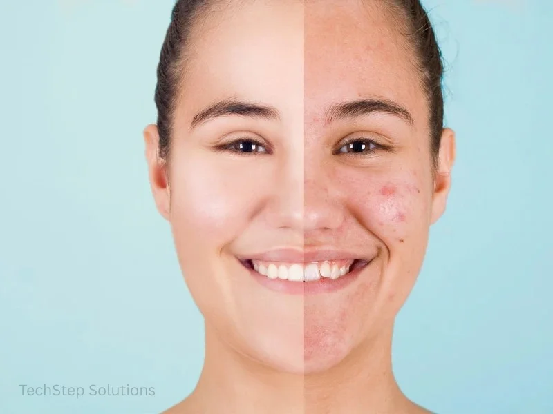 acne treatment results