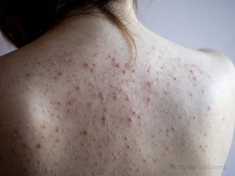 benefits of back acne treatment