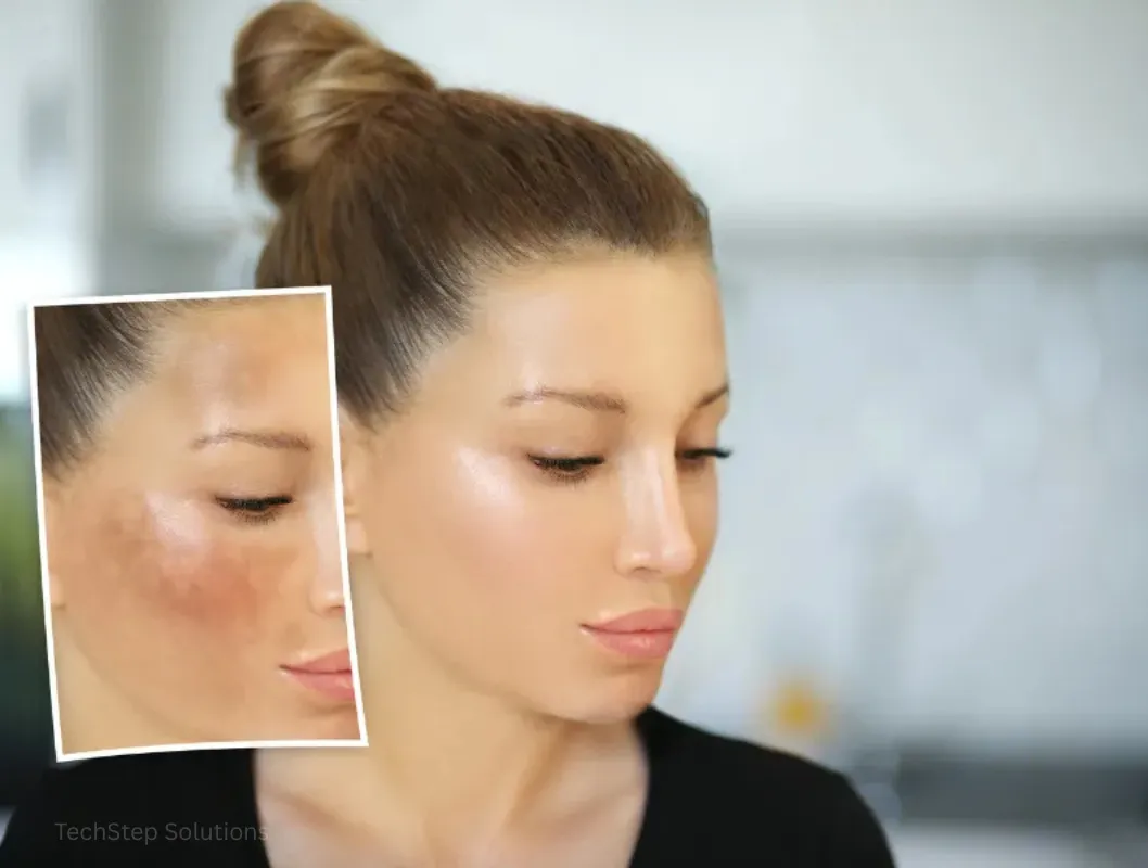 benefits of removal sunspot