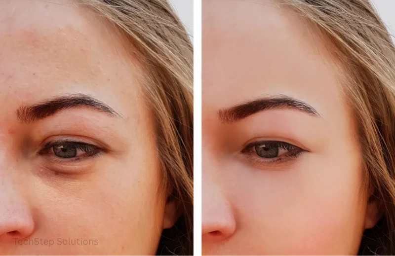chemical peel cost