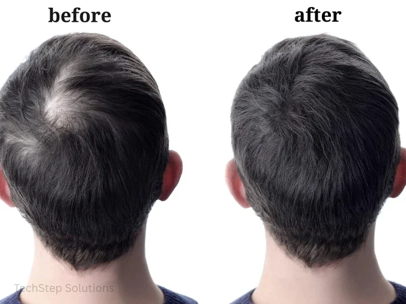 exosome hair treatment before and after