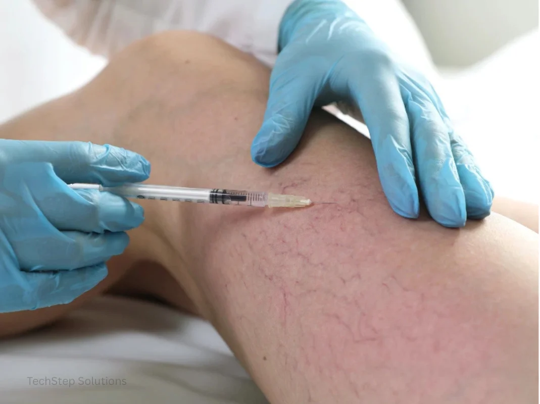 key benefits of sclerotherapy