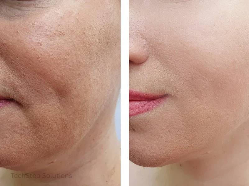 laser skin resurfacing results
