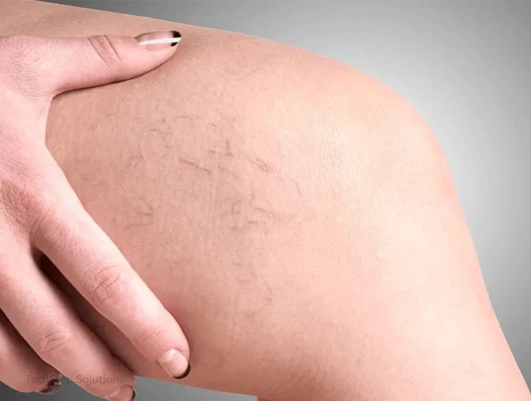 spider veins treatment cost