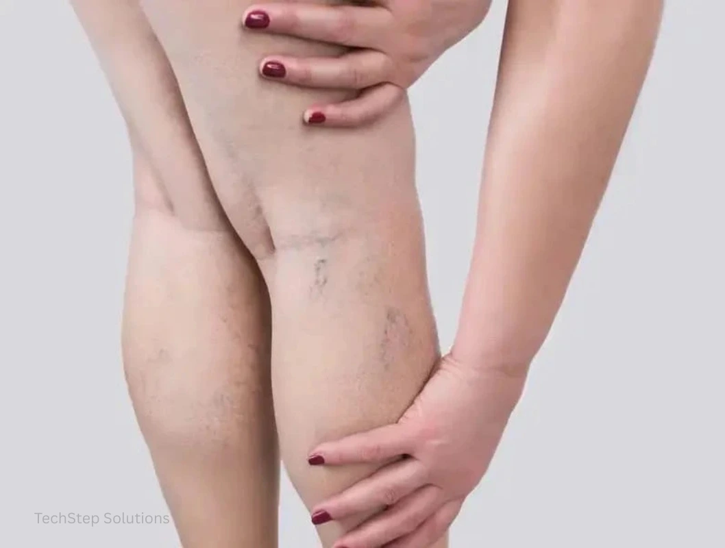 spider veins treatment