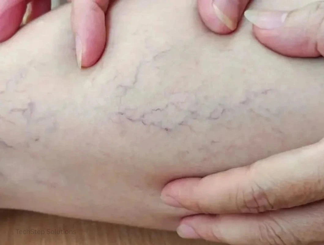 what are spider veins