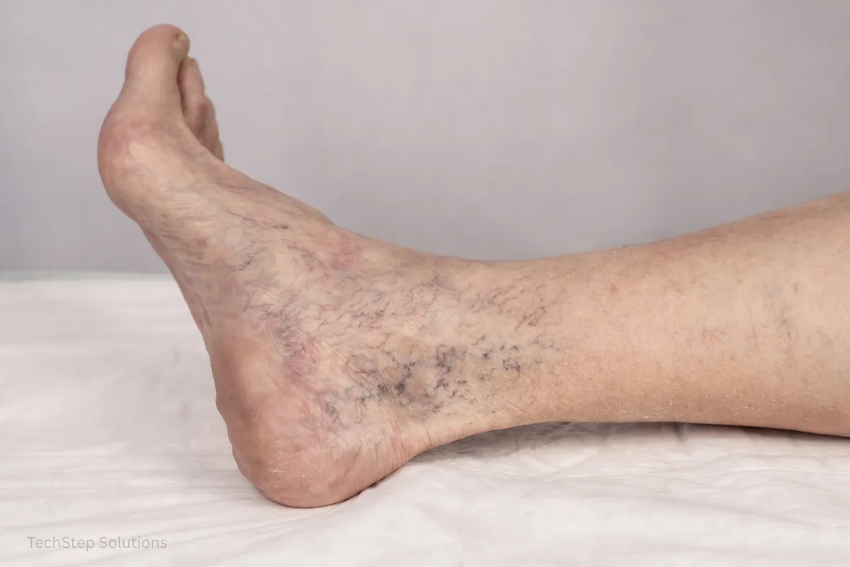spider vein treatment orange county california