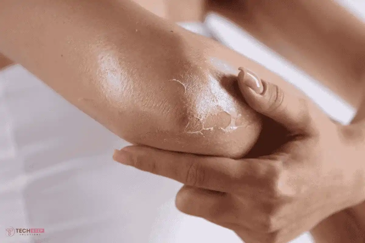 Aftercare Tips for elbow bleaching