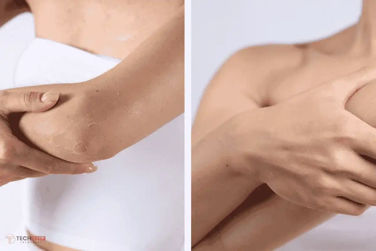 Benefits of Elbows Bleaching