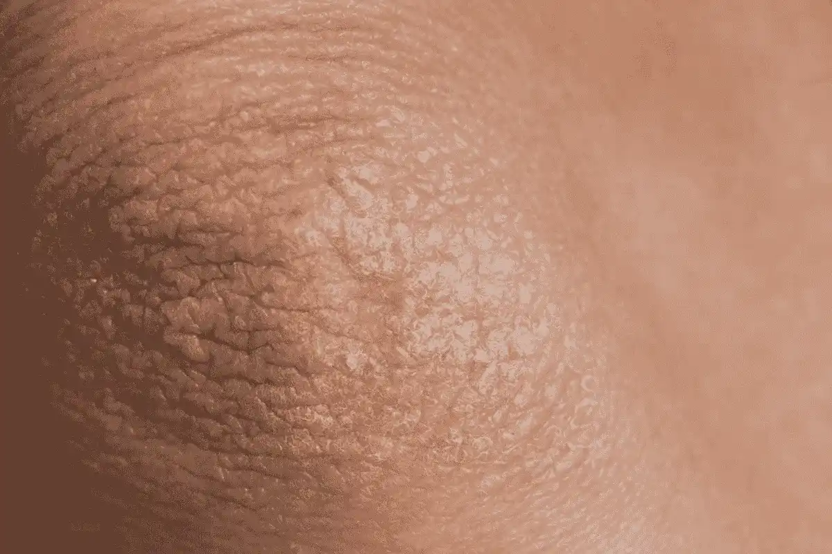 Ideal Candidates for Effective Elbows Bleaching