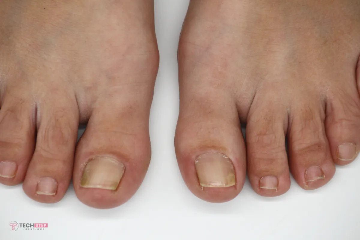 Expert Toenail Fungus Therapy