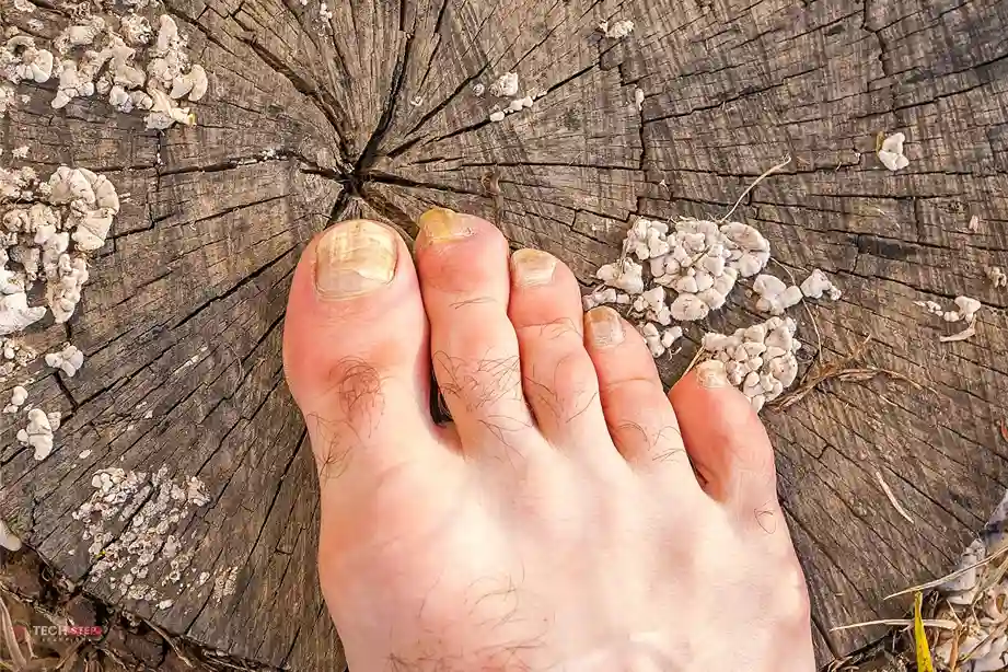 How Much Is Laser Toenail Fungus Treatment